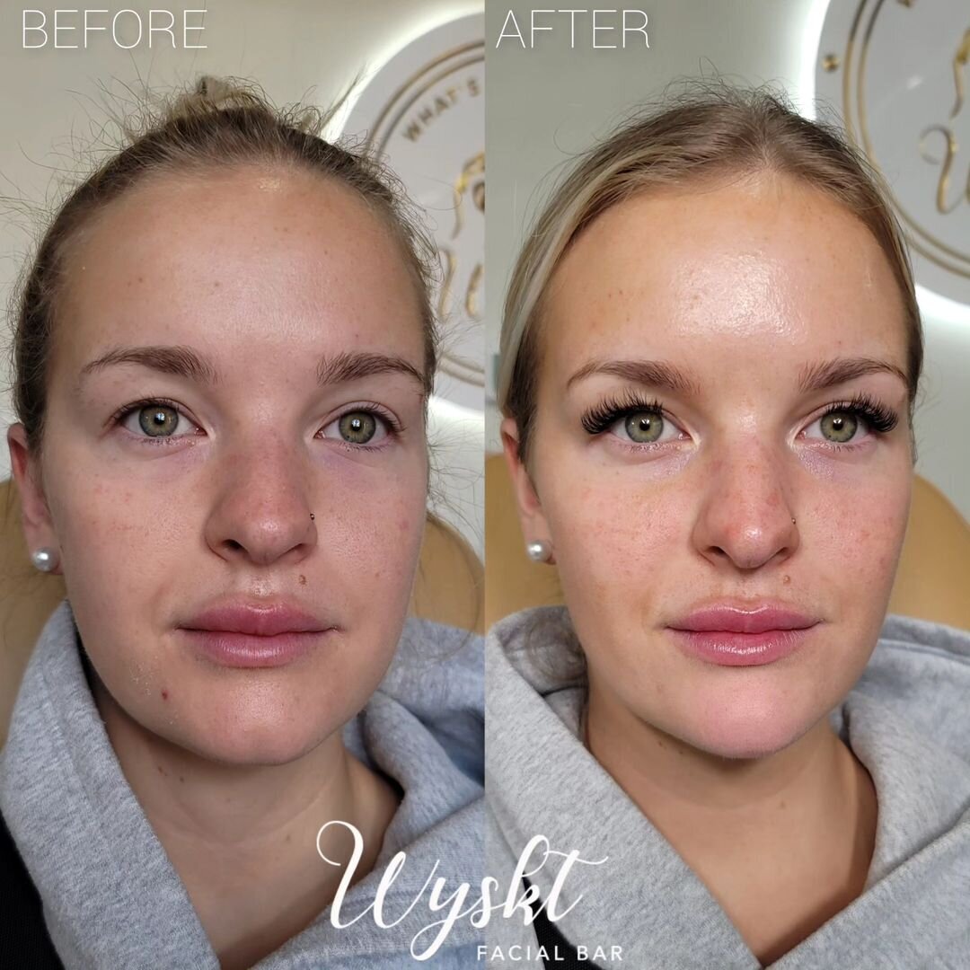 Wyskt-Facial-Bar-Before-After-Full-Face-Rejuvenation