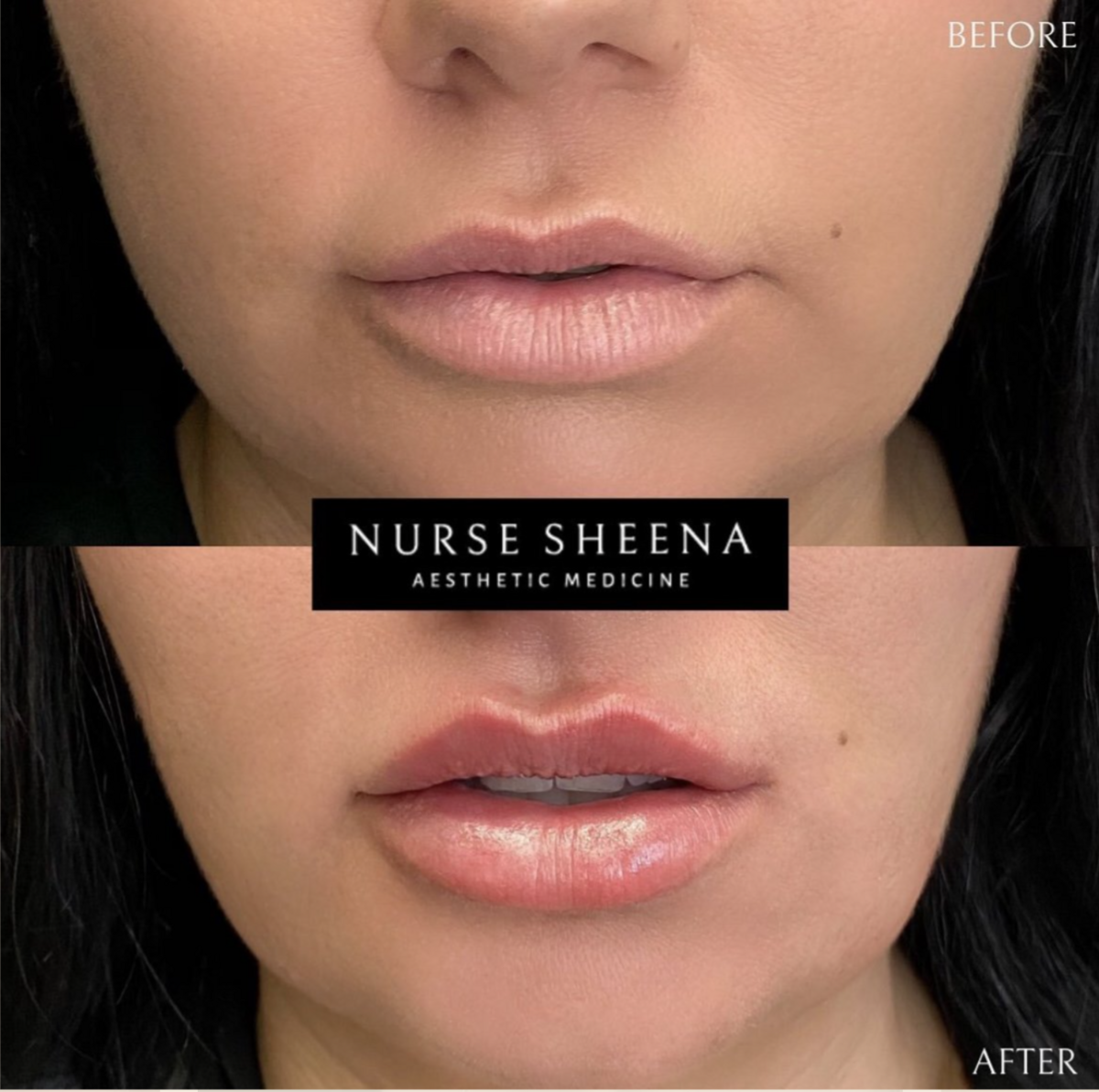 Lip Filler Results 10 by Nurse Sheena