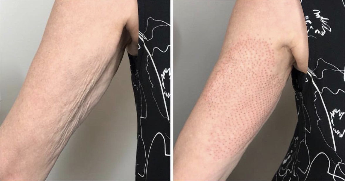 arms
