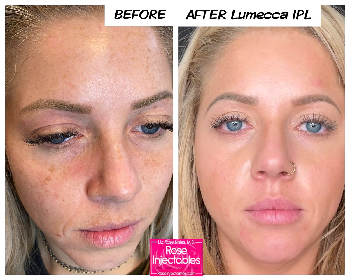 Lumecca IPL treatment before and after from Rose Injectables