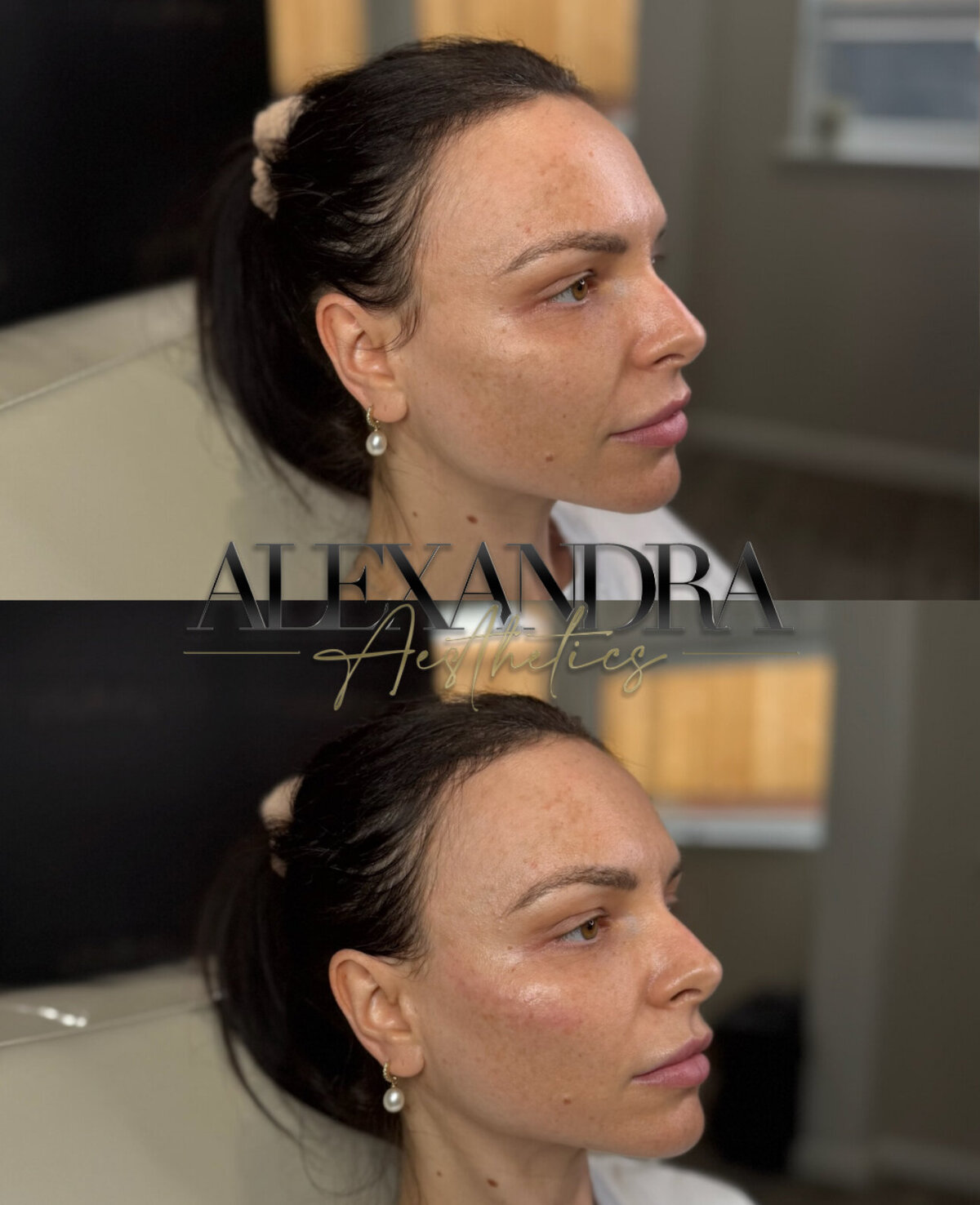 Skin rejuvenation facial treatment in Exeter clinic.