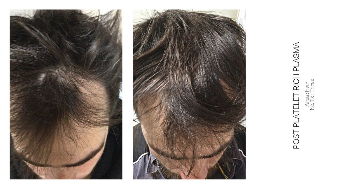 PRP Hair Before and After 1