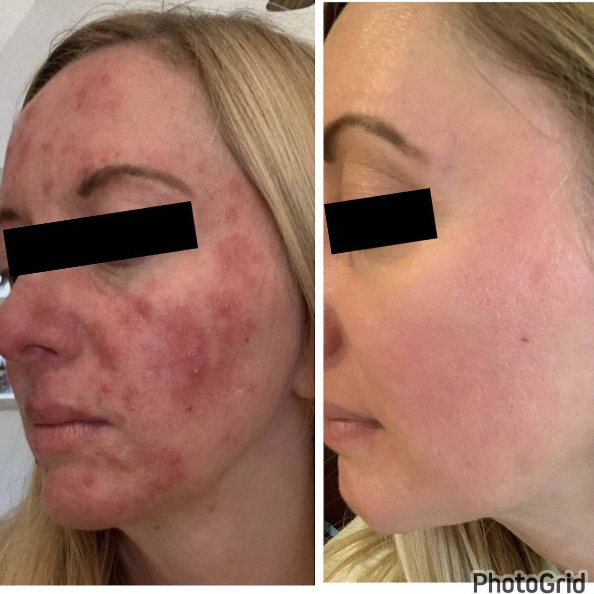 3 - Before and After Client Transformation Images 2024 - The Rosacea Method - Dr Tara Odesky 