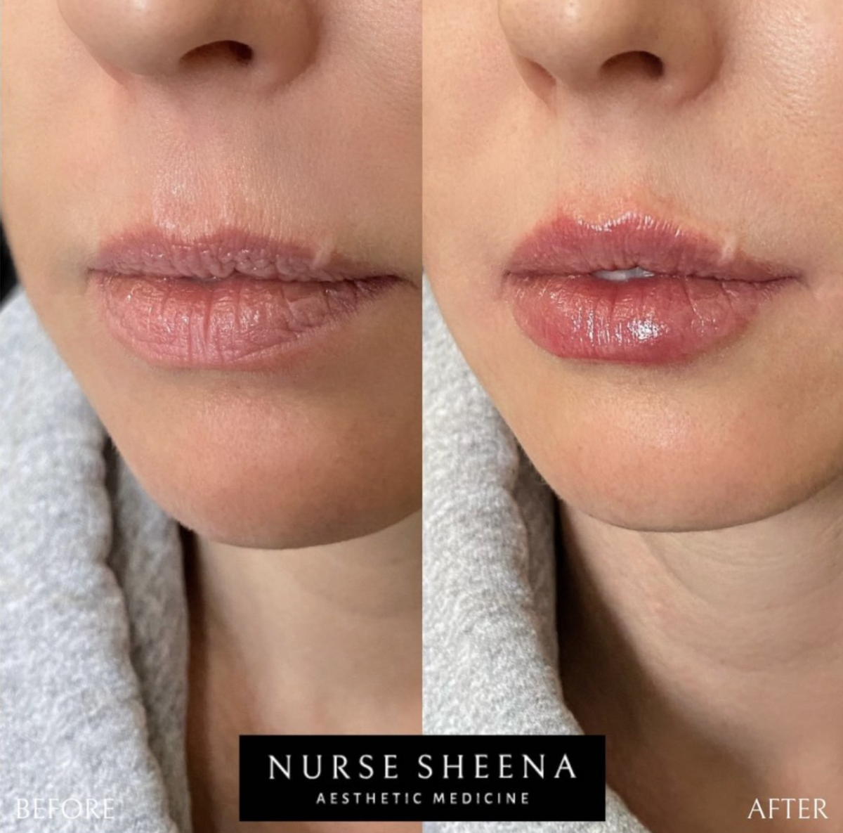 Lip Filler Results 3 by Nurse Sheena