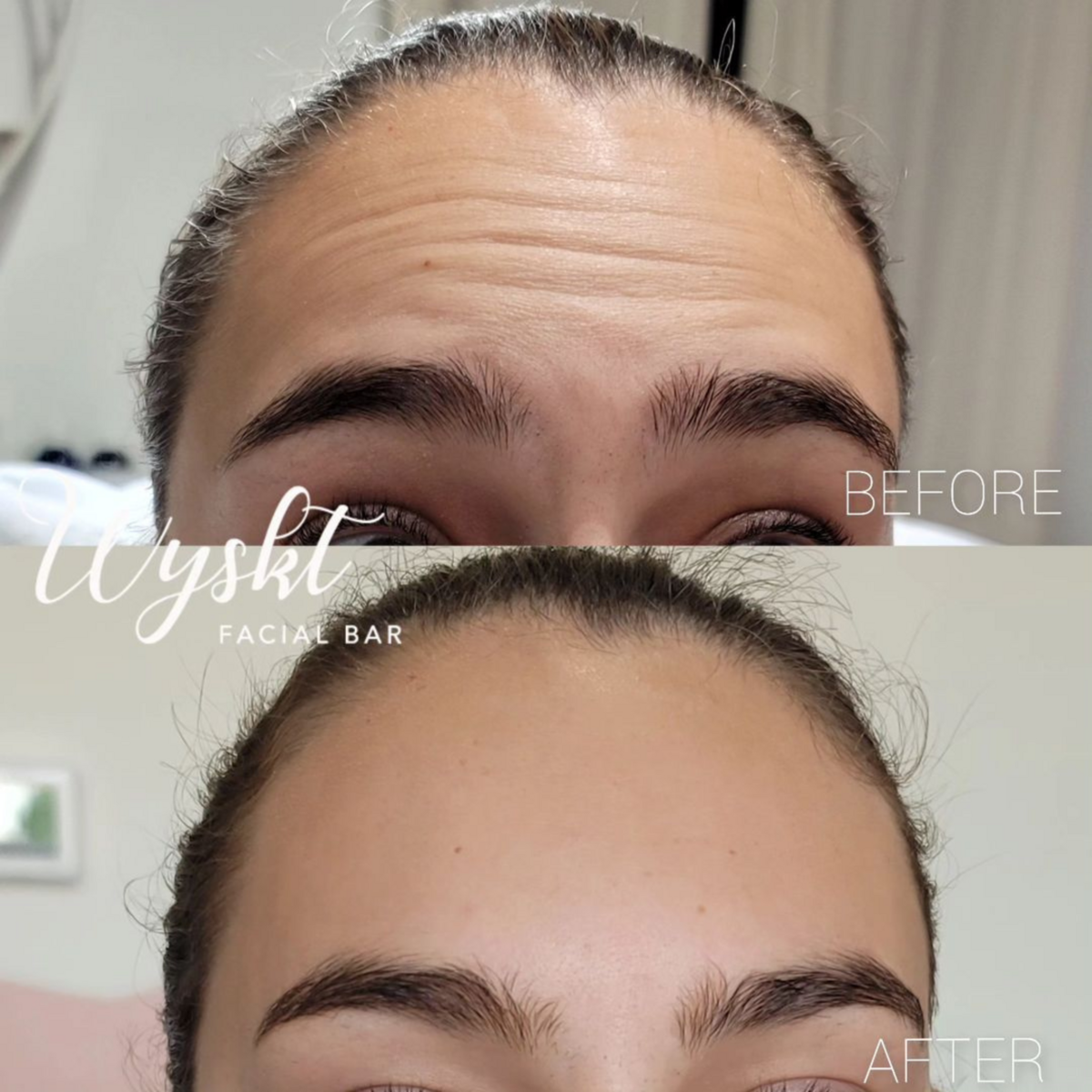 Anti-Wrinkle Injectable Results