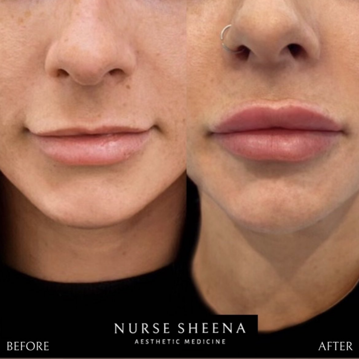 Lip Filler Results by Nurse Sheena