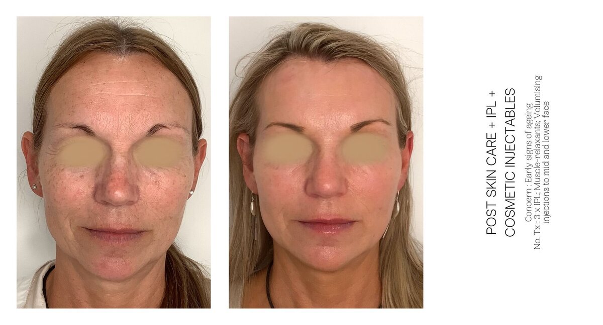 Early Signs of Ageing Before and After 1