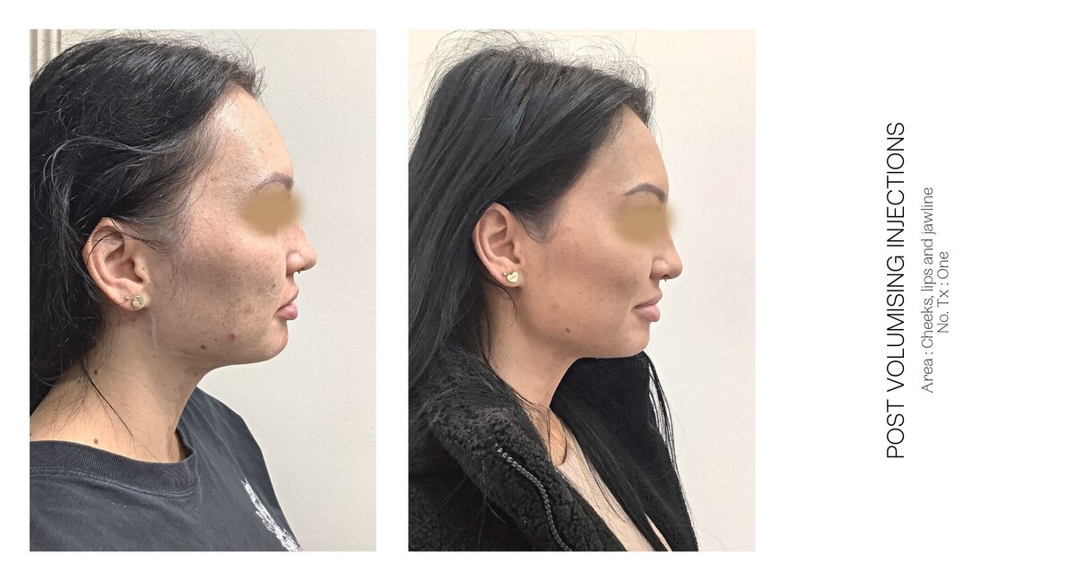 Cheek Injectable Before and After 2