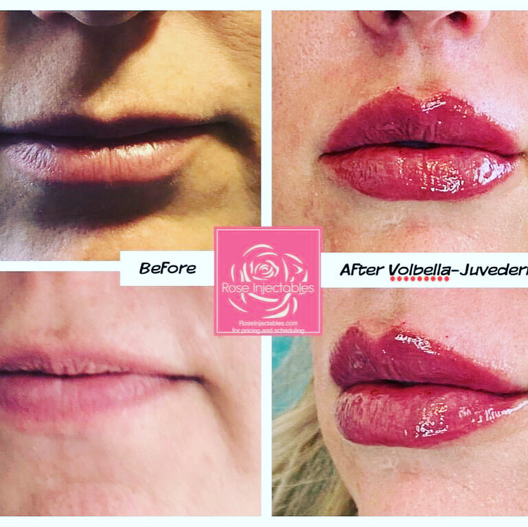 Before and after photos of lip fillers  done at Canon City's Rose Injectables