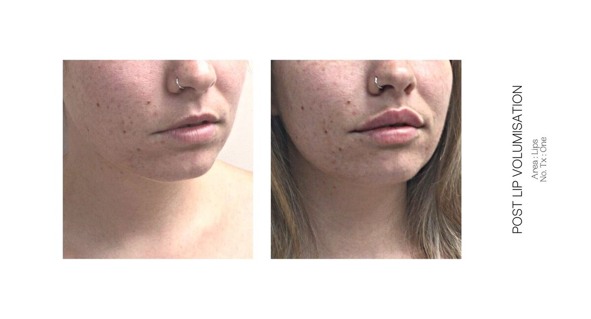 Best South Coast Lip Injection Before and After 20