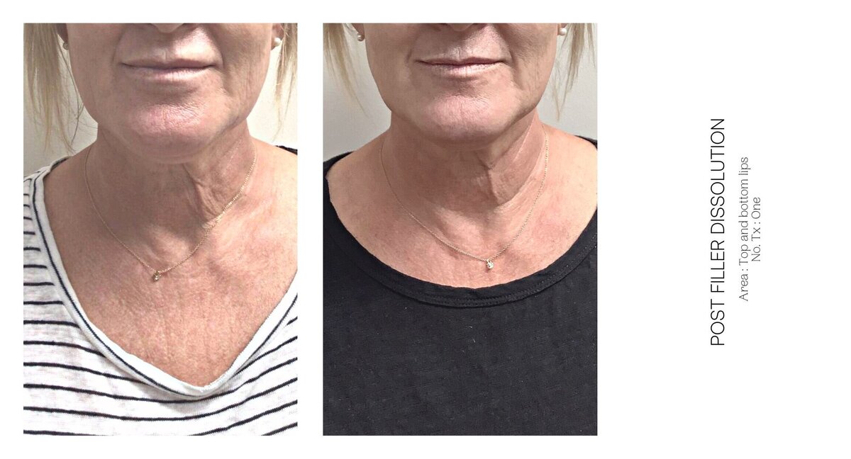 Top Lip Filler Dissolve Before and After 4