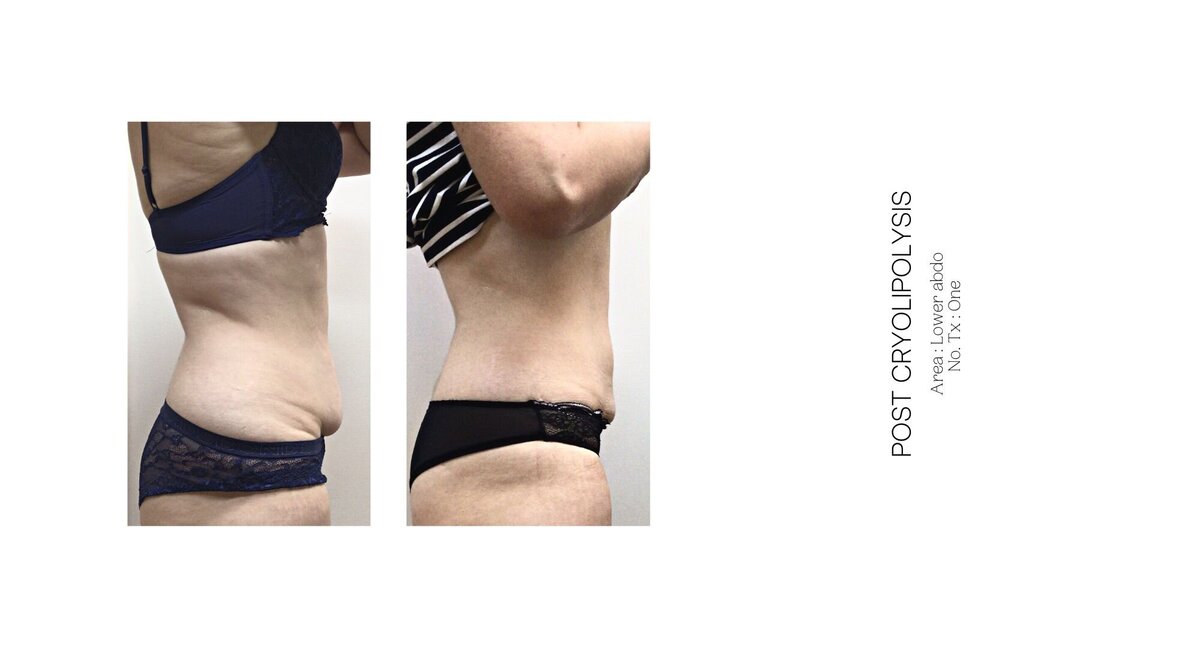 Cryolipolysis Lower Stomach Before and After 2
