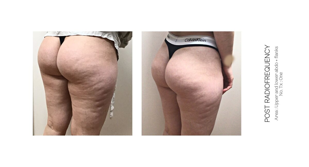 Radiofrequency Before and After