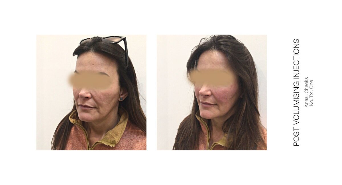 Cheek Injectable Before and After 12