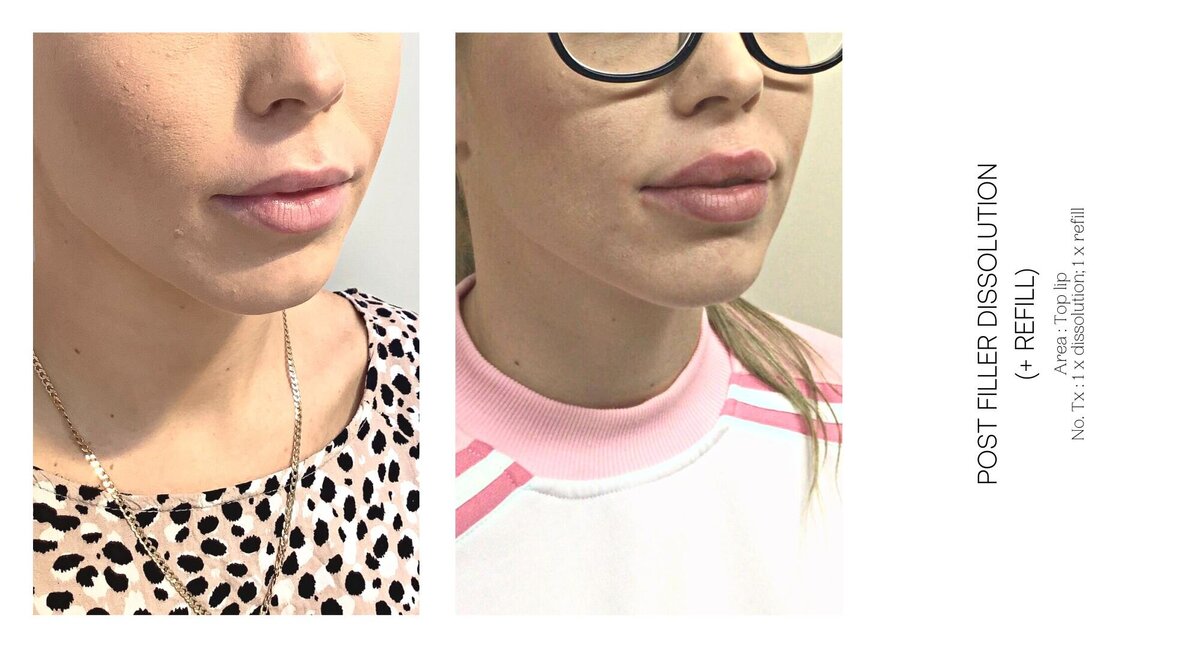 Top Lip Filler Dissolve Before and After 1