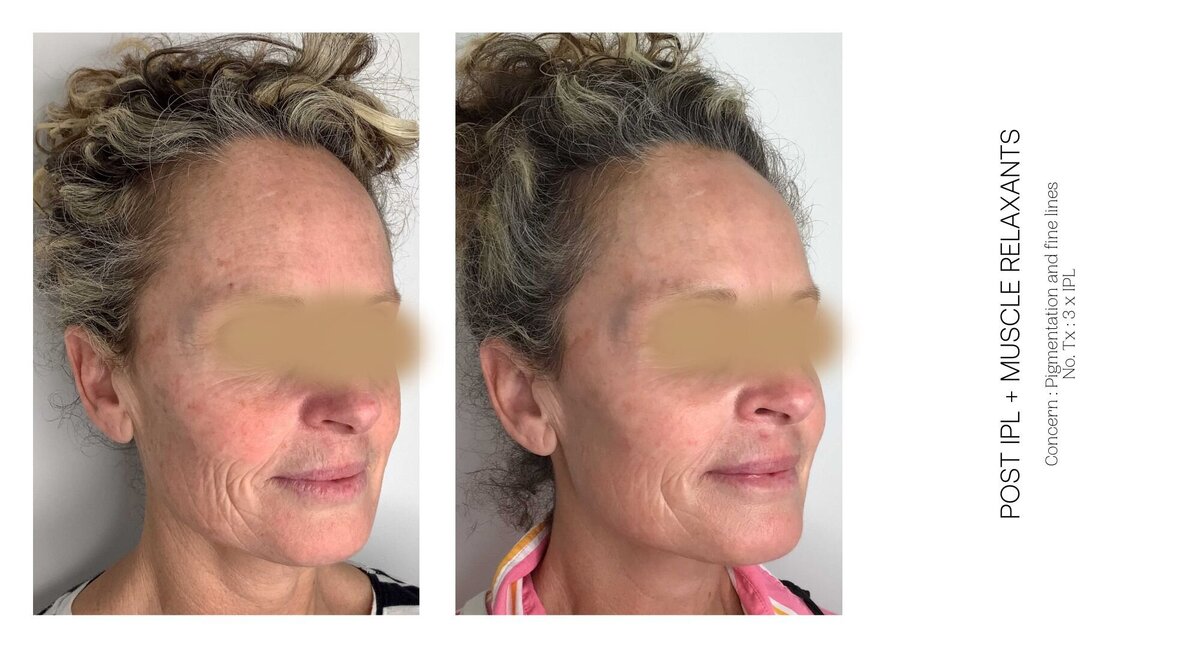 Skin Pigmentation and Fine Line Before and After 1