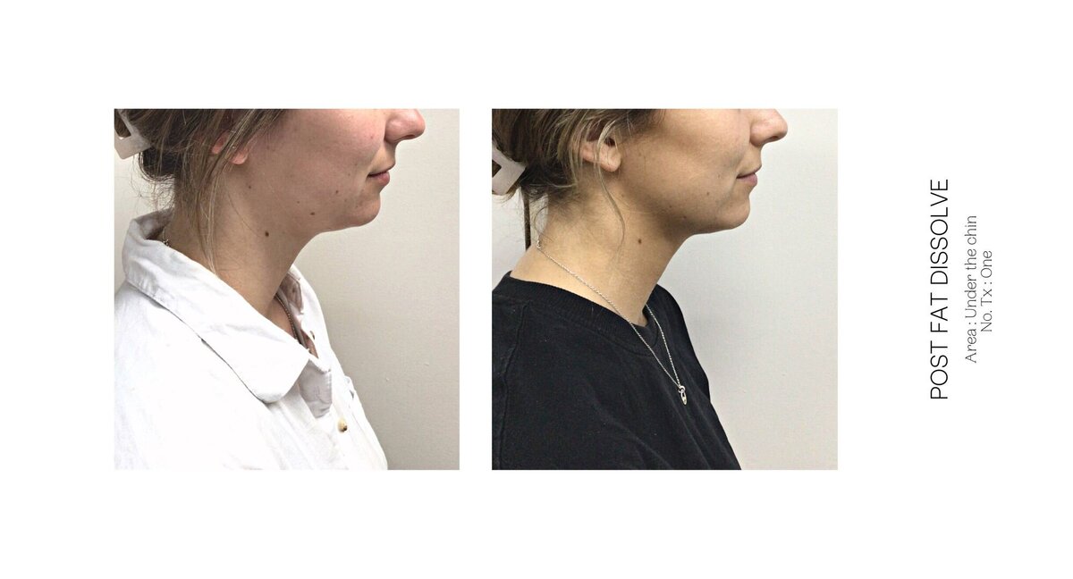 Under Chin Fat Dissolve Before and After 7