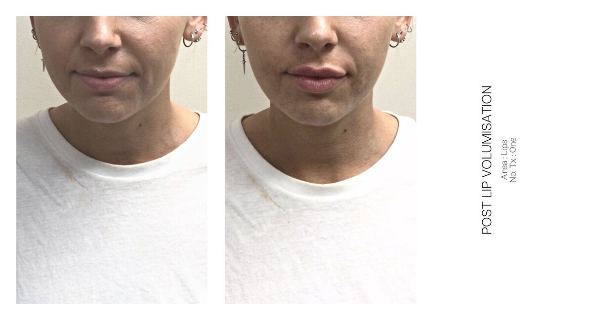 Best South Coast Lip Injection Before and After 3