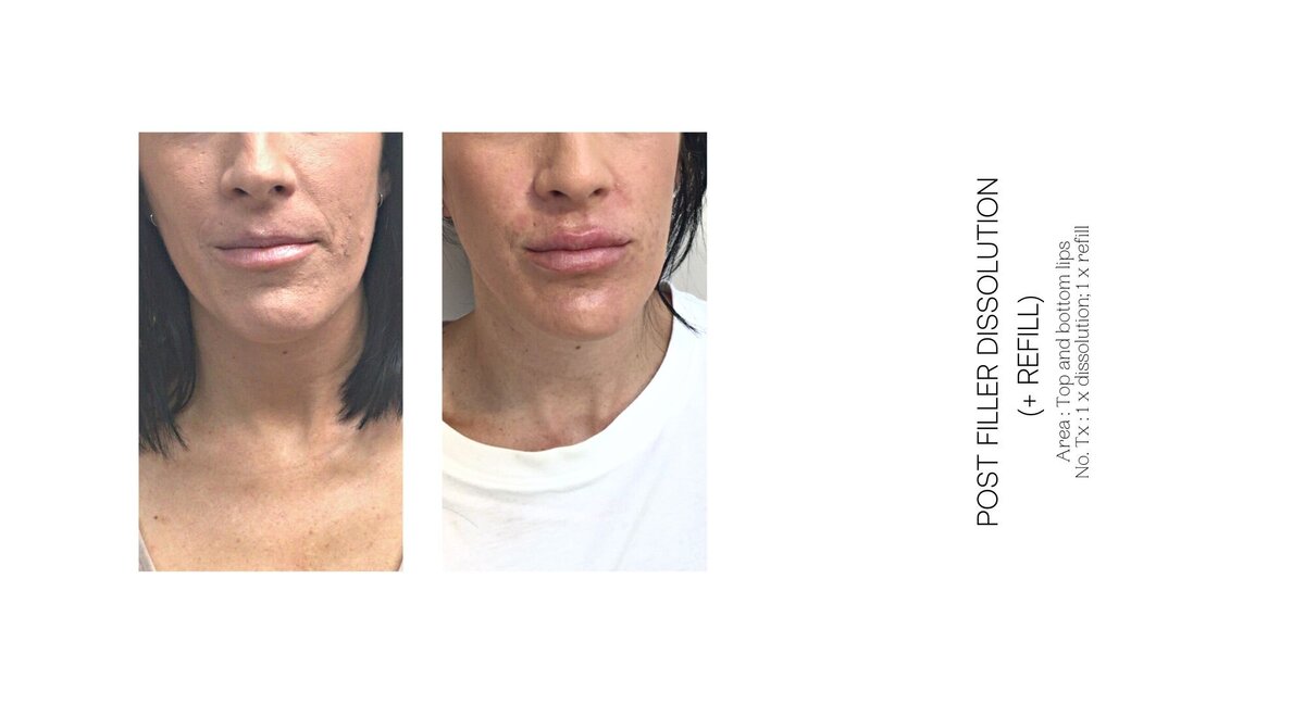 Lip Filler Dissolve Before and After 3
