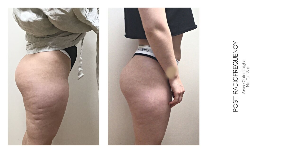 Radiofrequency Outer Thighs Before and After