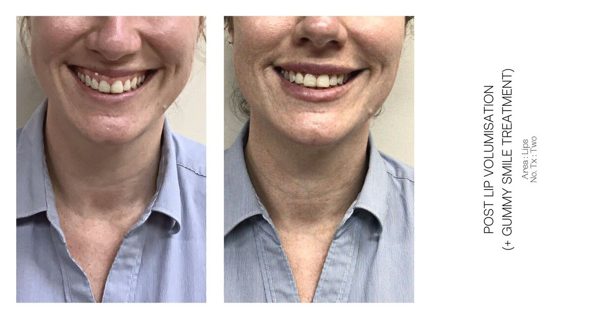 Best South Coast Lip Injection Before and After 51