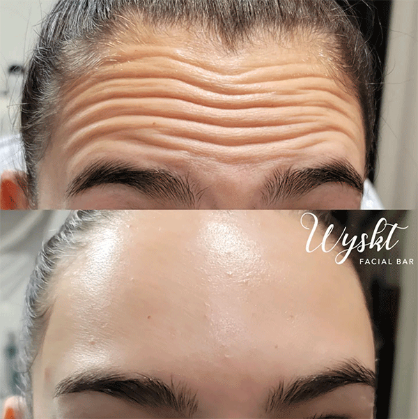 Anti-Wrinkle Injectable Results