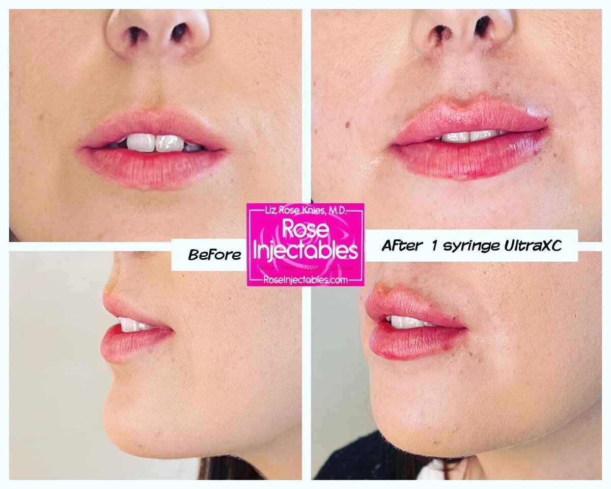 Lip filler before and after photo