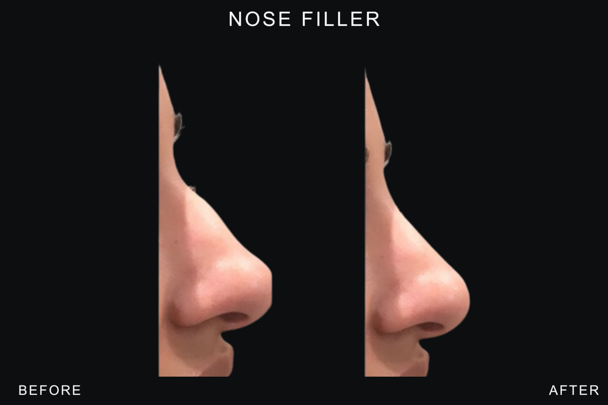 Nose 2