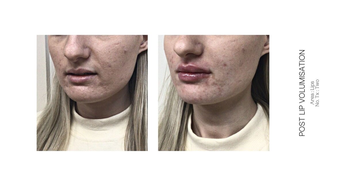 Best South Coast Lip Injection Before and After 16