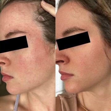 1 - Before and After Client Transformation Images 2024 - The Rosacea Method - Dr Tara Odesky 