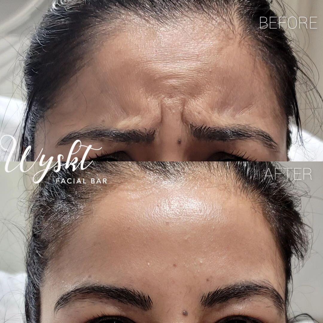 Anti-Wrinkle Injectable B&A