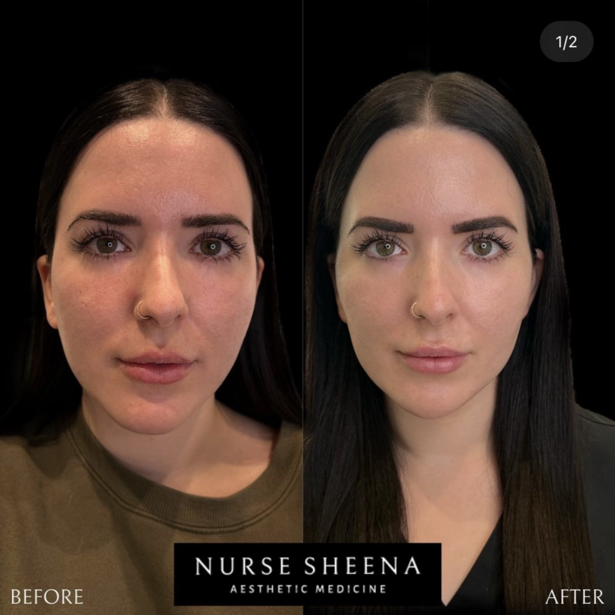 Full Face Injections by Nurse Sheena