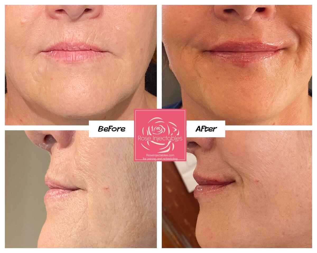 Dermal lip filler before and after by Rose Injectables in Canon City