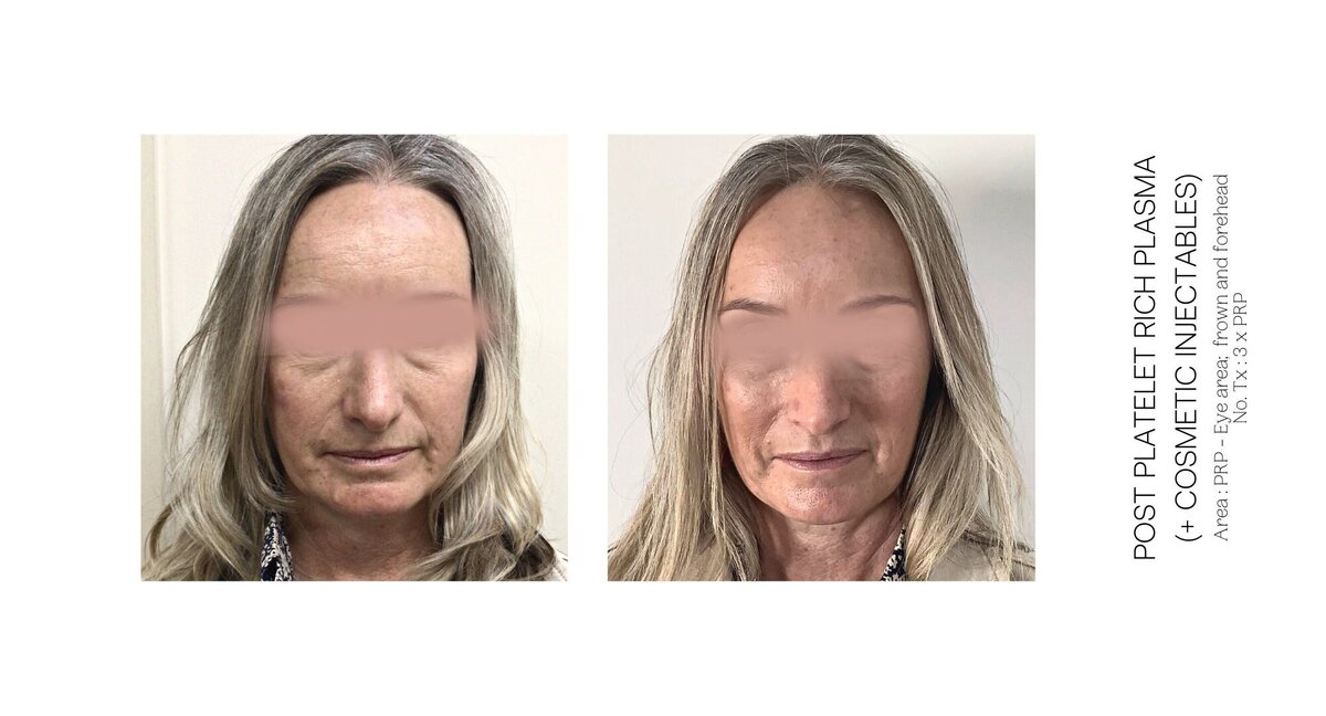 PRP Under Eye Before and After 3