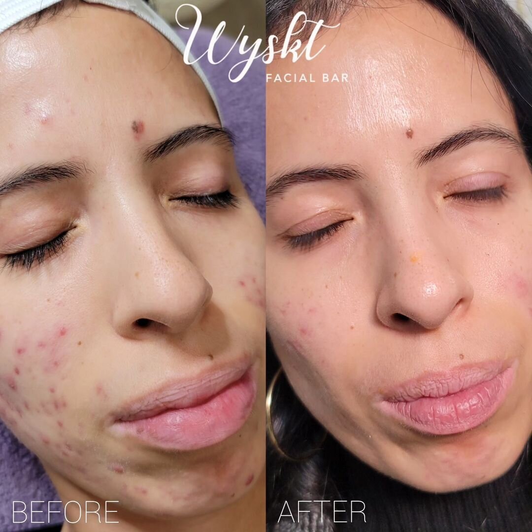Acne Clearing & Scar Reduction Results