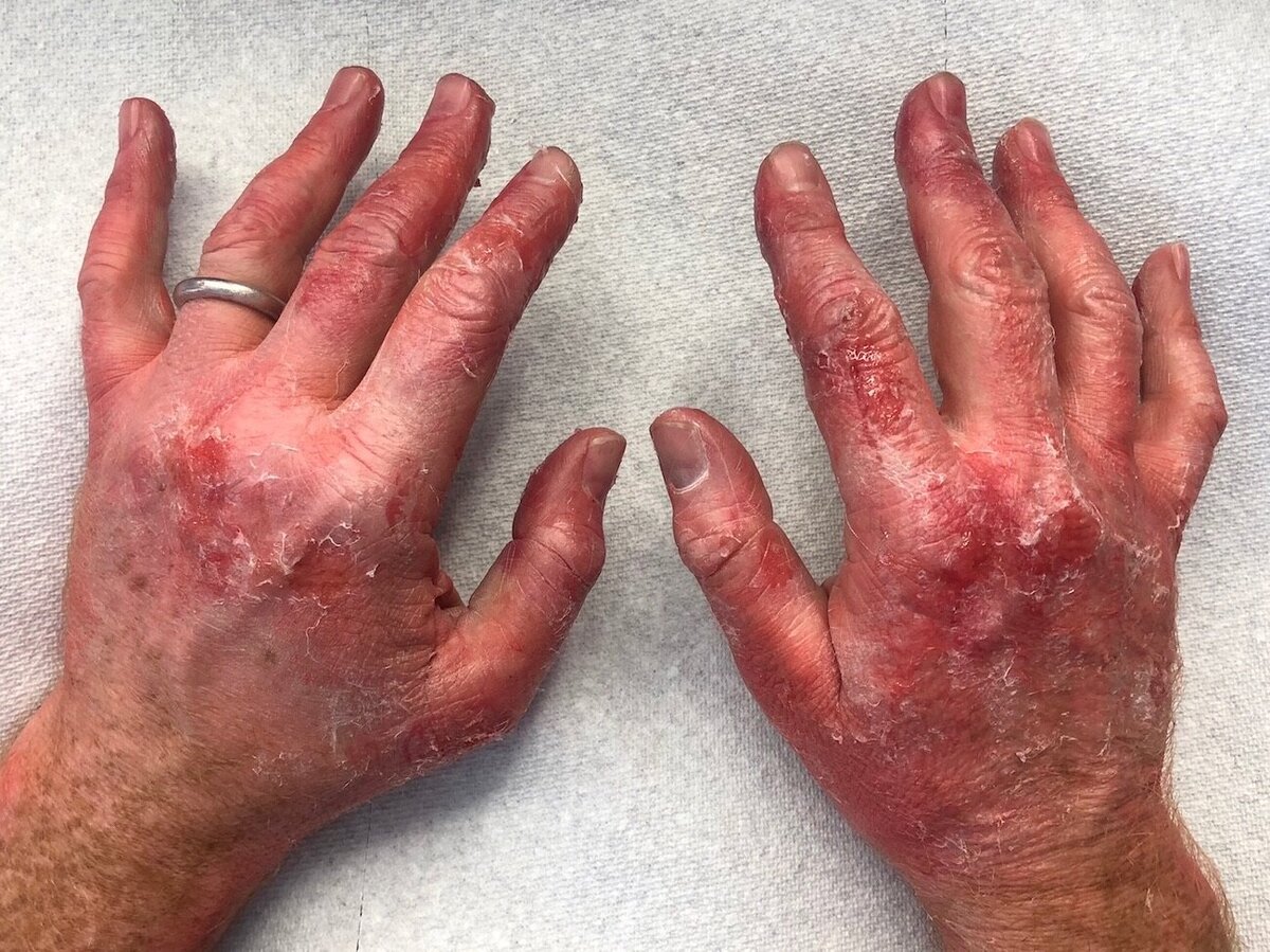 fake-red-blistered-hands-makeup-fx-vancouver