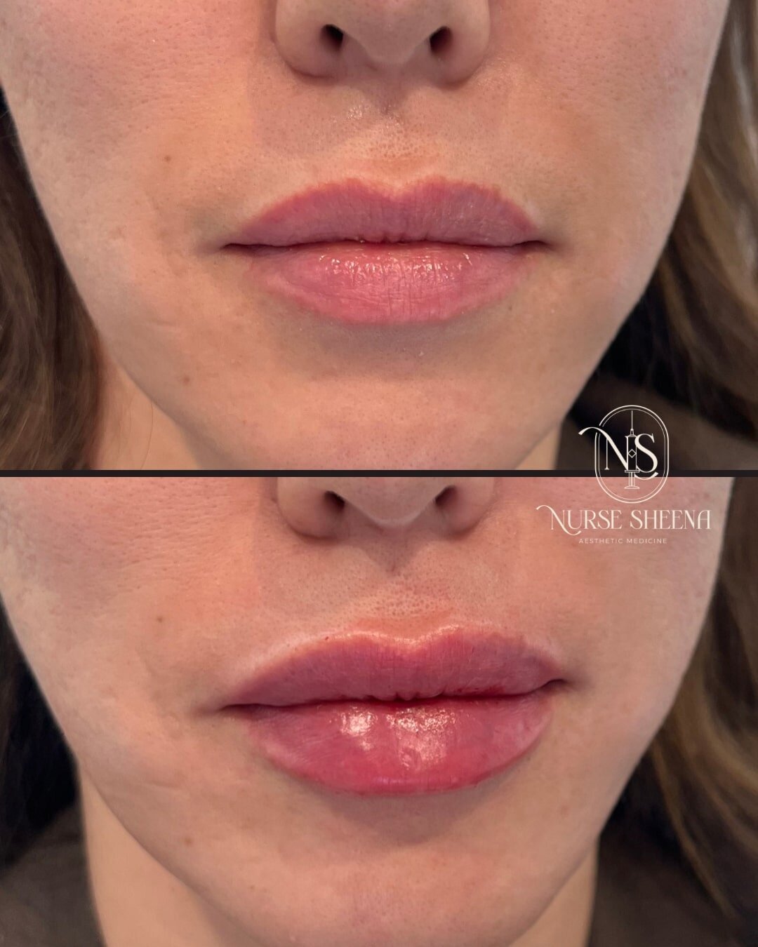 Lip Fillers Before and After Results