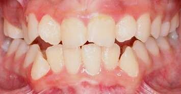 paner teeth before braces