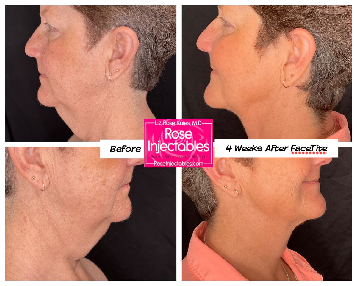 Before and after photo of a minimally invasive face contouring procedure called Facetite completed by Dr. Knies at Rose Injectables
