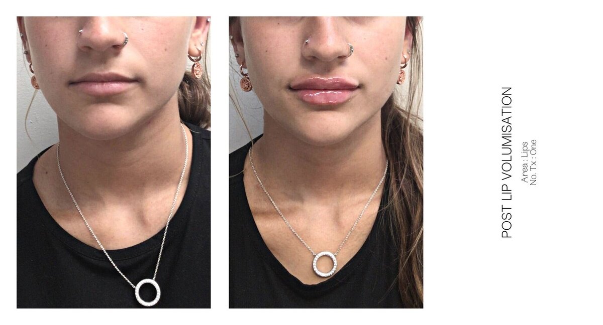 Best South Coast Lip Injection Before and After 26