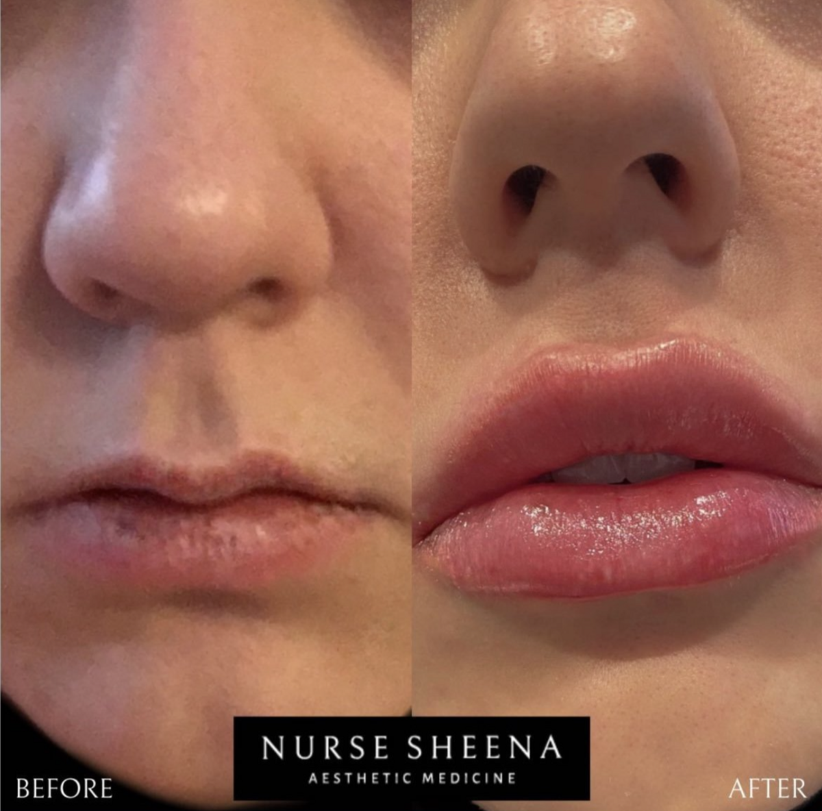 Lip Filler Results 4 by Nurse Sheena