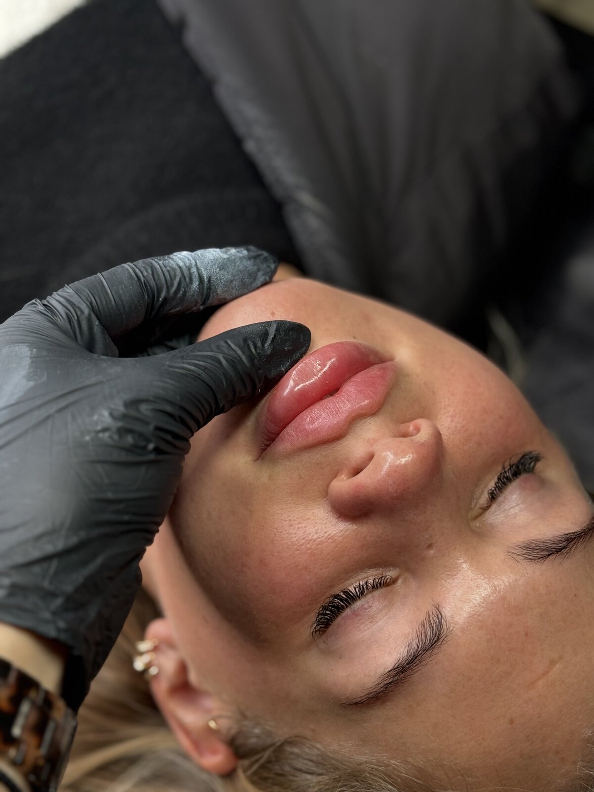 Lip filler results at Alexandra Aesthetics in Exeter.