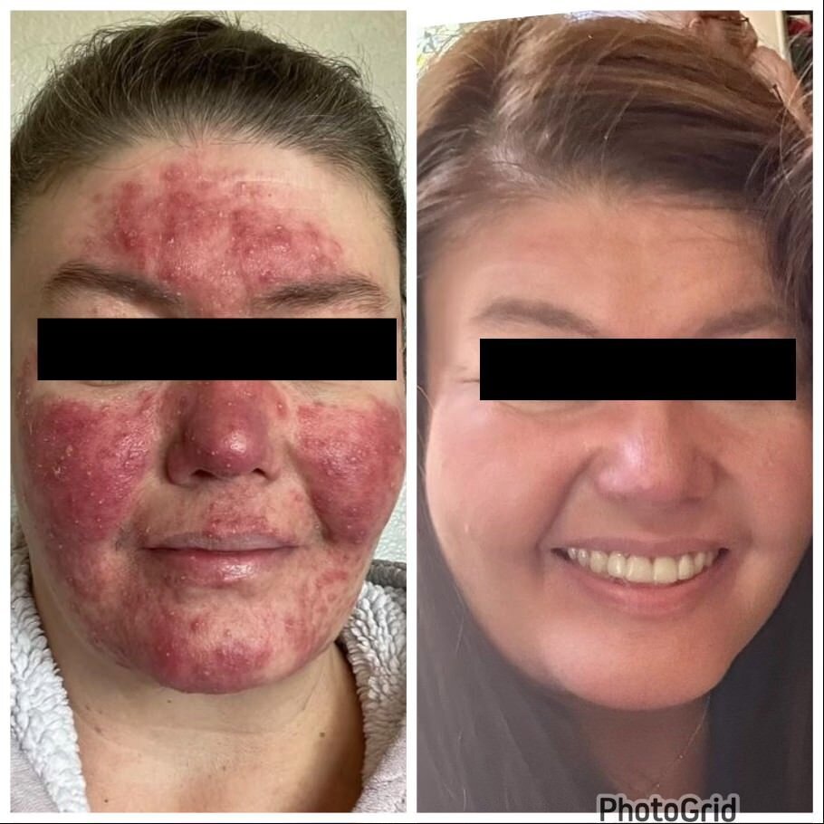 4 - Before and After Client Transformation Images 2024 - The Rosacea Method - Dr Tara Odesky 