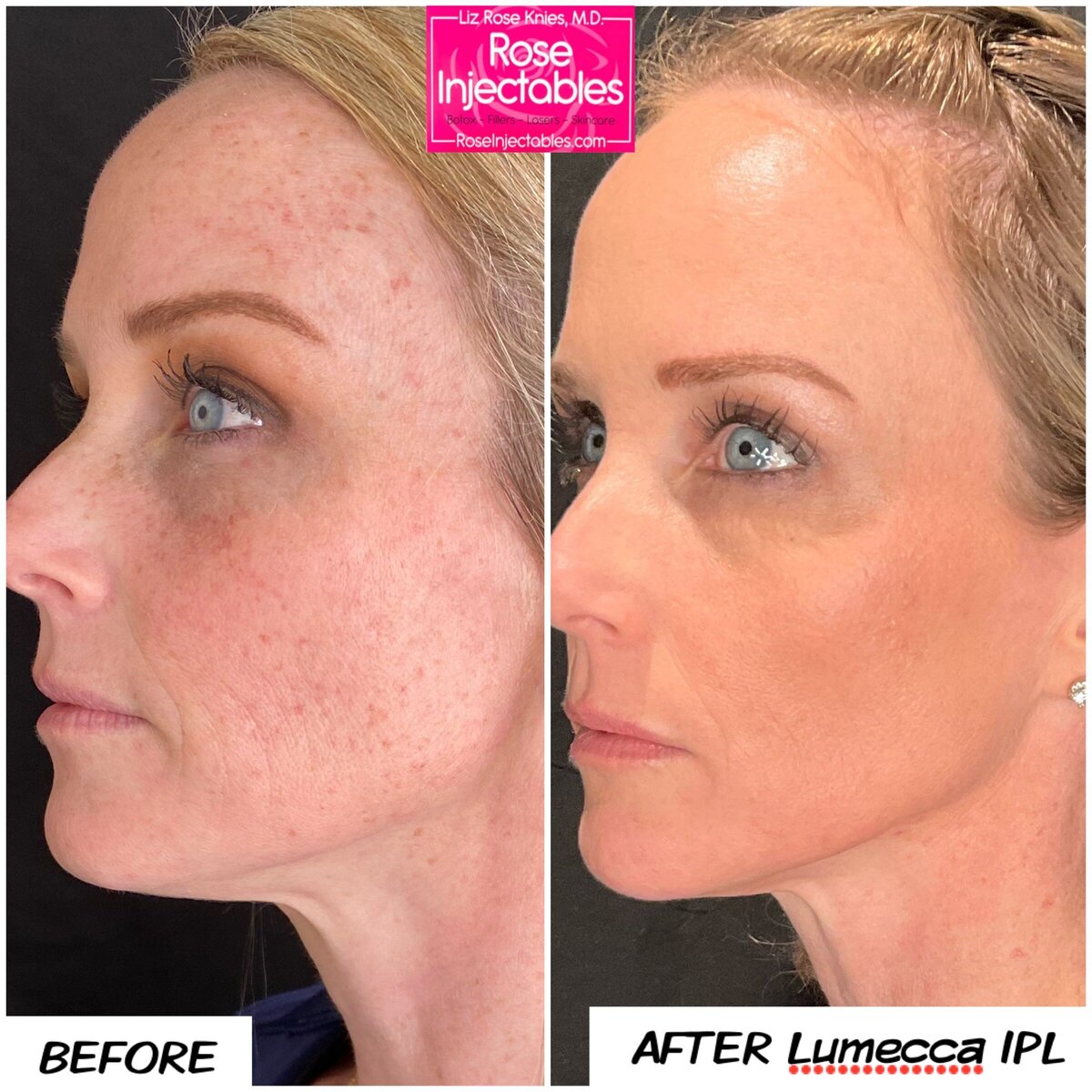 Before and after photos of Lumecca IPL procedure at Rose Injectables