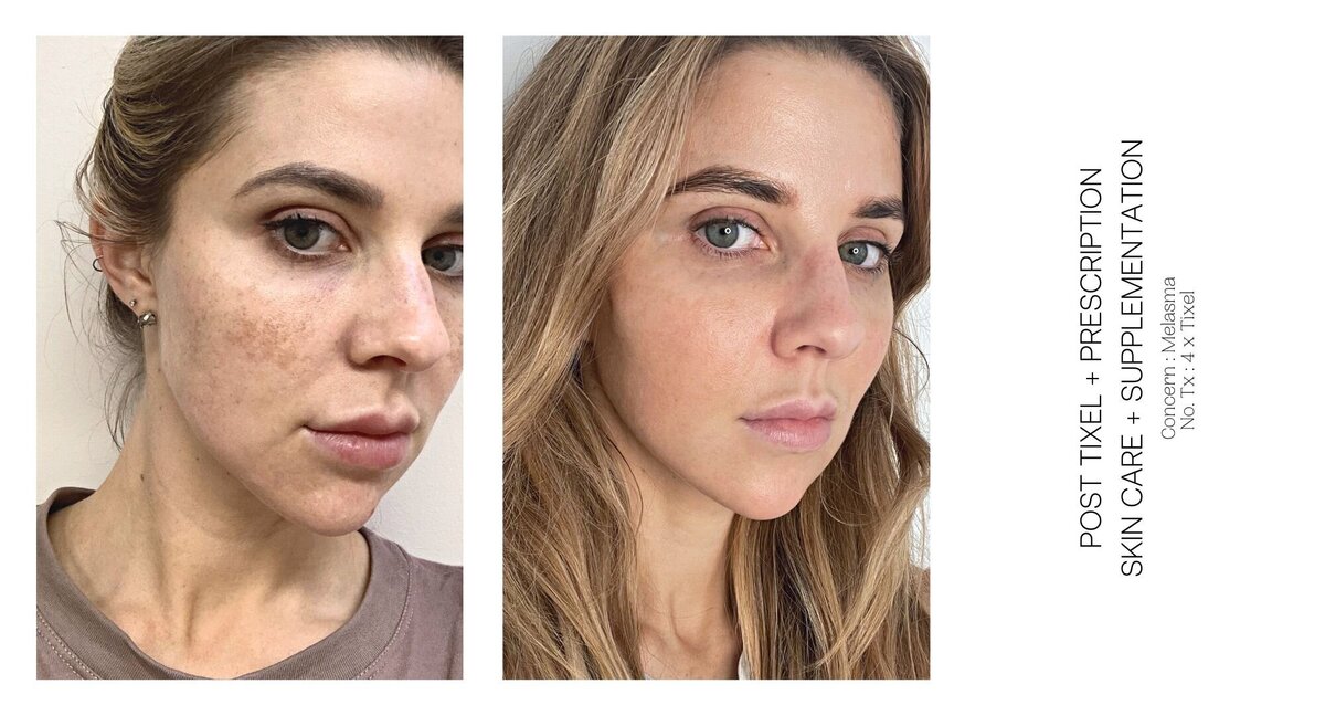 Melasma Before and After 3
