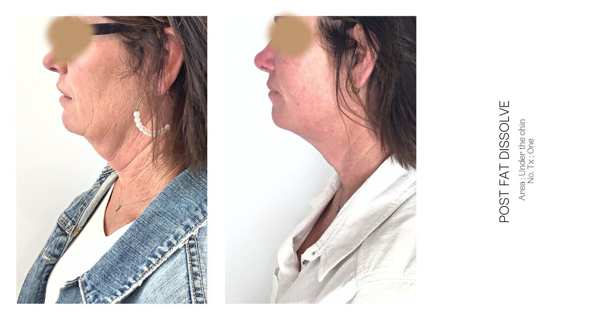 Under Chin Fat Dissolve Before and After 3