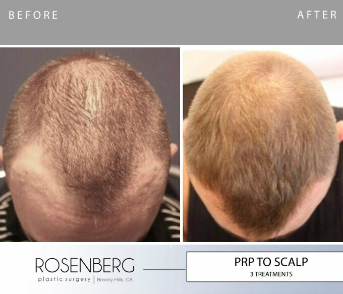 PRP to Scalp Beofre & After