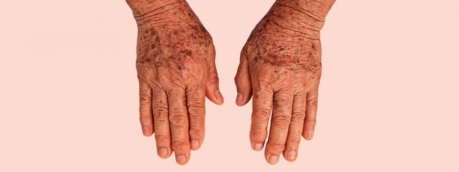 ouderdomsvlekken pigment ultra skin clinic huidtherapie