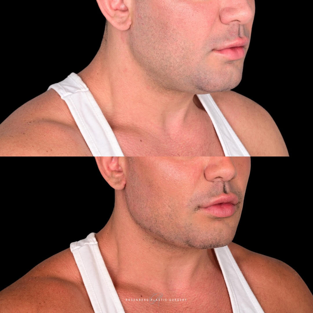 Neck Liposuction Results