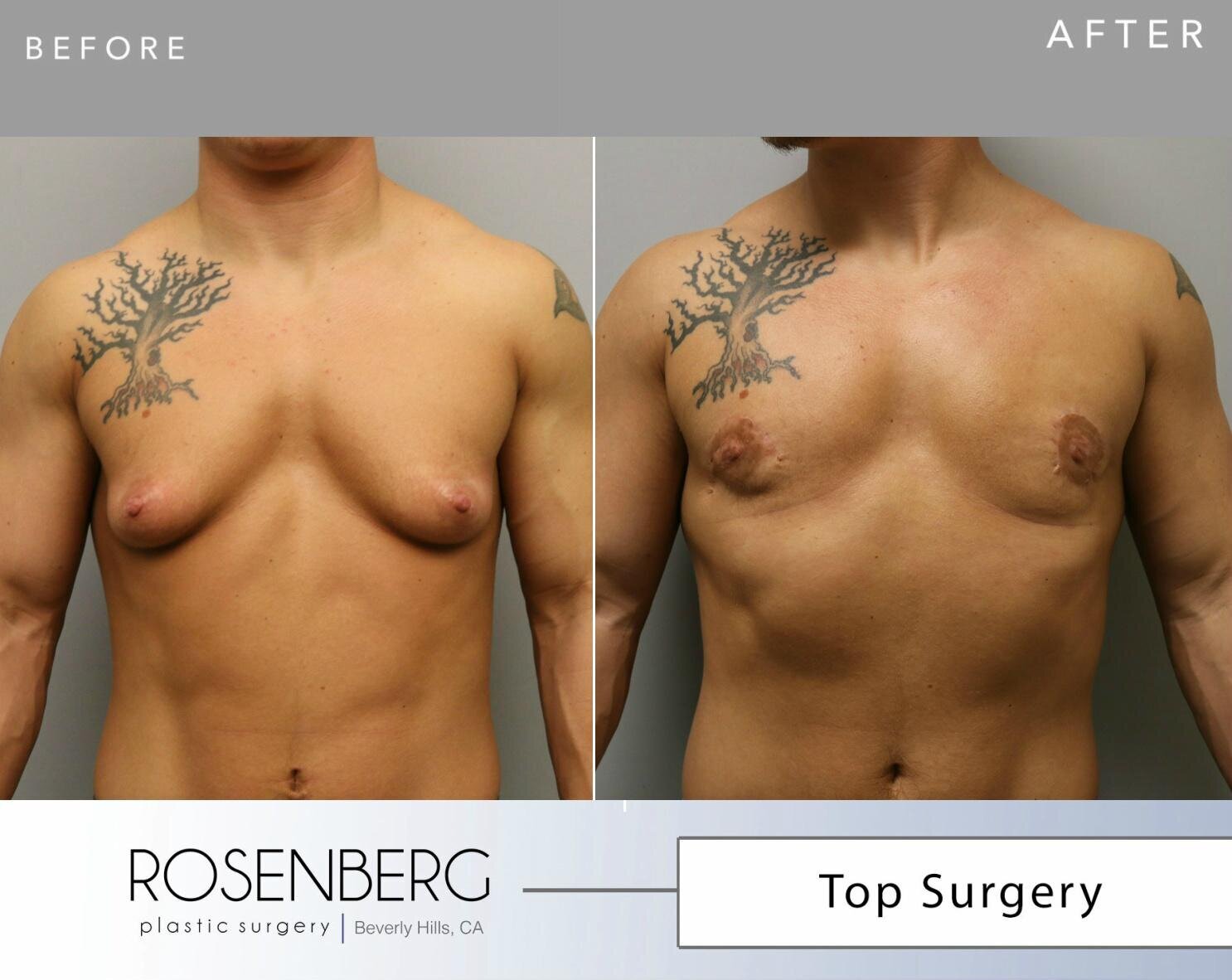 Top Surgery Results